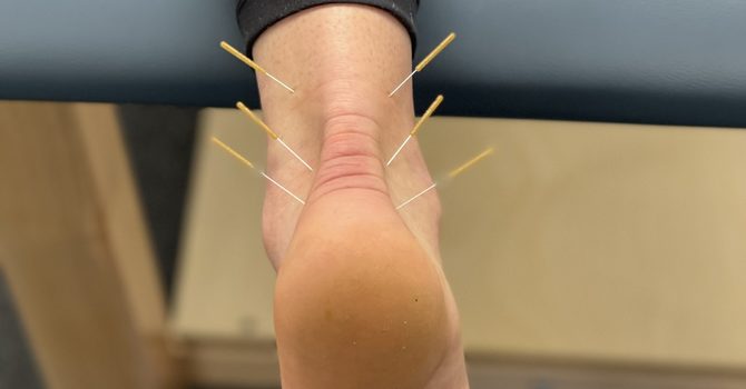 Dry Needling
